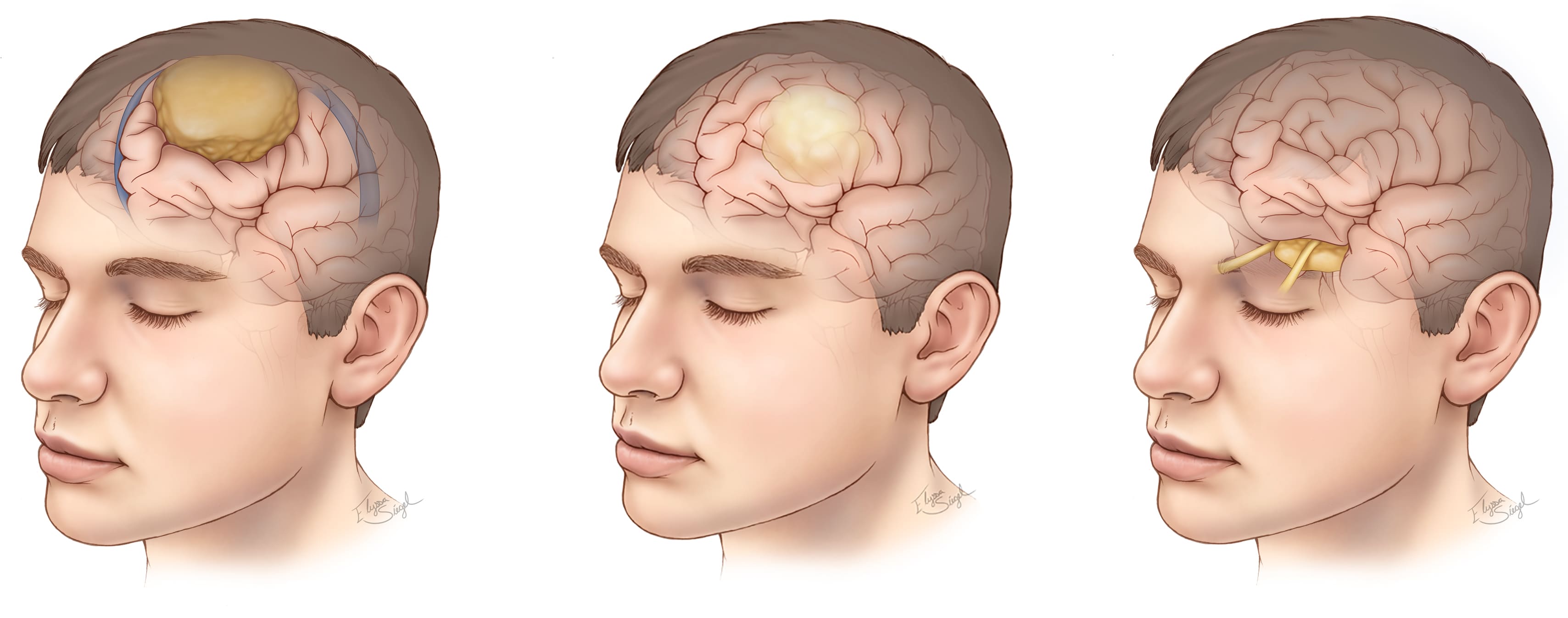 symptoms-of-brain-tumor-health-tips-from-kokilaben-hospital